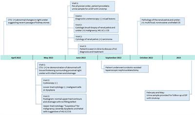 Clinical utility of urinary comprehensive genomic profiling in diagnosing metachronous upper tract urothelial carcinoma: a case report